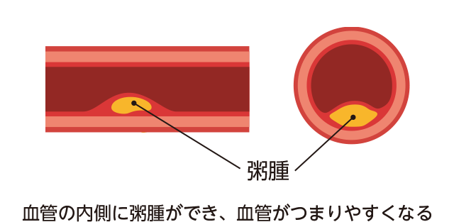 アテローム動脈硬化