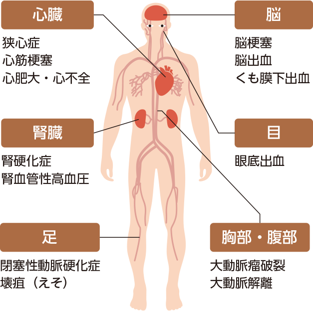 高血圧から起こる病気